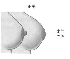 奶水丰盈时， 内陷乳头更难哺乳