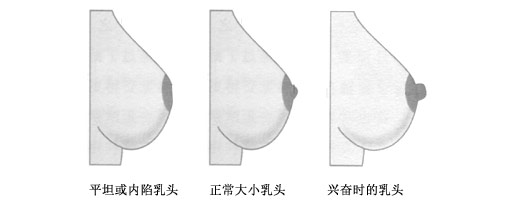 不同状态时的乳头侧面图比较，内陷乳头，正常乳头和兴奋乳头