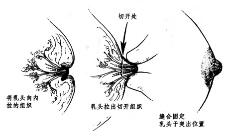 手术治疗乳头内陷一般原理图